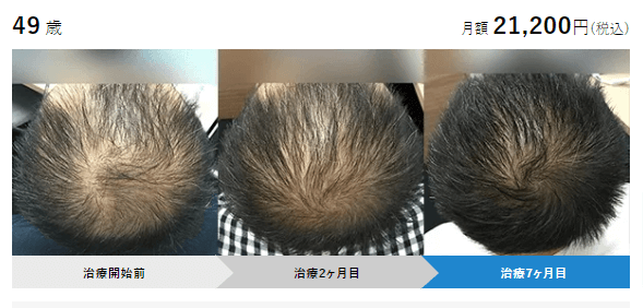 AGAヘアクリニックの症例画像